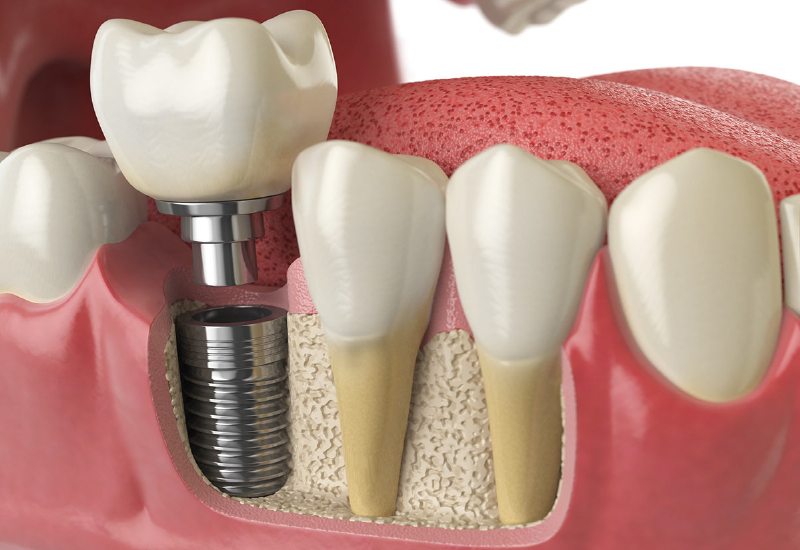 IMPIANTI DENTALI