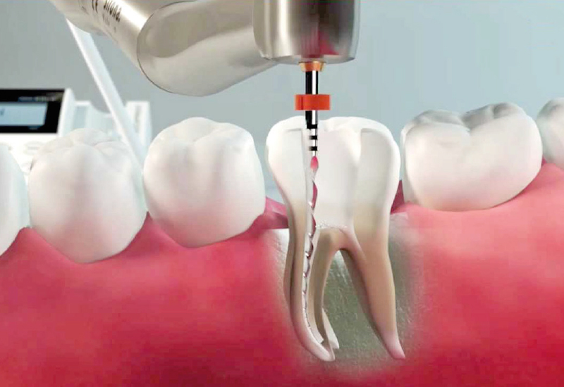 ENDODONZIA